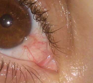 Dipyridamol eye drops